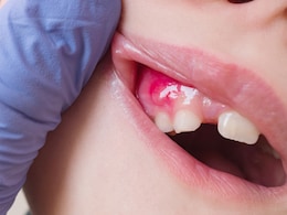 सूज गए हैं मसूड़े तो नमक में मिलाकर लगा लें यह एक चीज, Swollen Gums को मिल जाएगा आराम सूज गए हैं मसूड़े तो नमक में मिलाकर लगा लें यह एक चीज, Swollen Gums को मिल जाएगा आराम