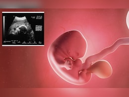 Fetus in Fetu : 4 दिवसांपूर्वी जन्मलेल्या मुलीच्या पोटात बाळ; रिपोर्ट पाहून डॉक्टरही हादरले!  Fetus in Fetu : 4 दिवसांपूर्वी जन्मलेल्या मुलीच्या पोटात बाळ; रिपोर्ट पाहून डॉक्टरही हादरले!