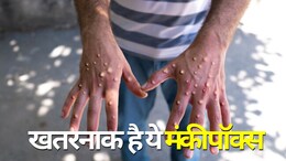 क्या भारत में पैर पसार रहा है मंकीपॉक्स ? क्यों है ये इतना खतरनाक, यहां समझिए&nbsp;