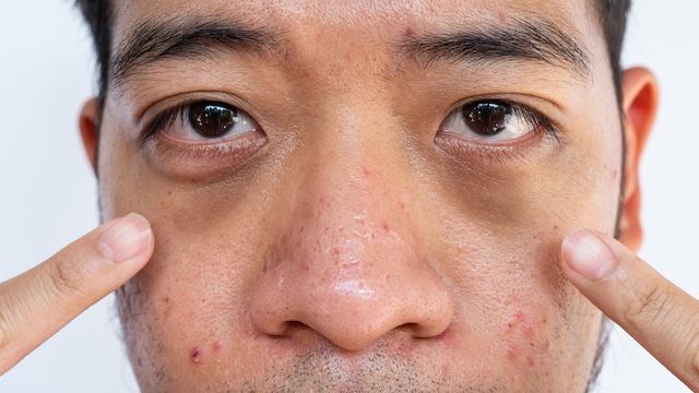 Dark circles can occur due to multiple reasons but medical treatment is necessary when it become too dark