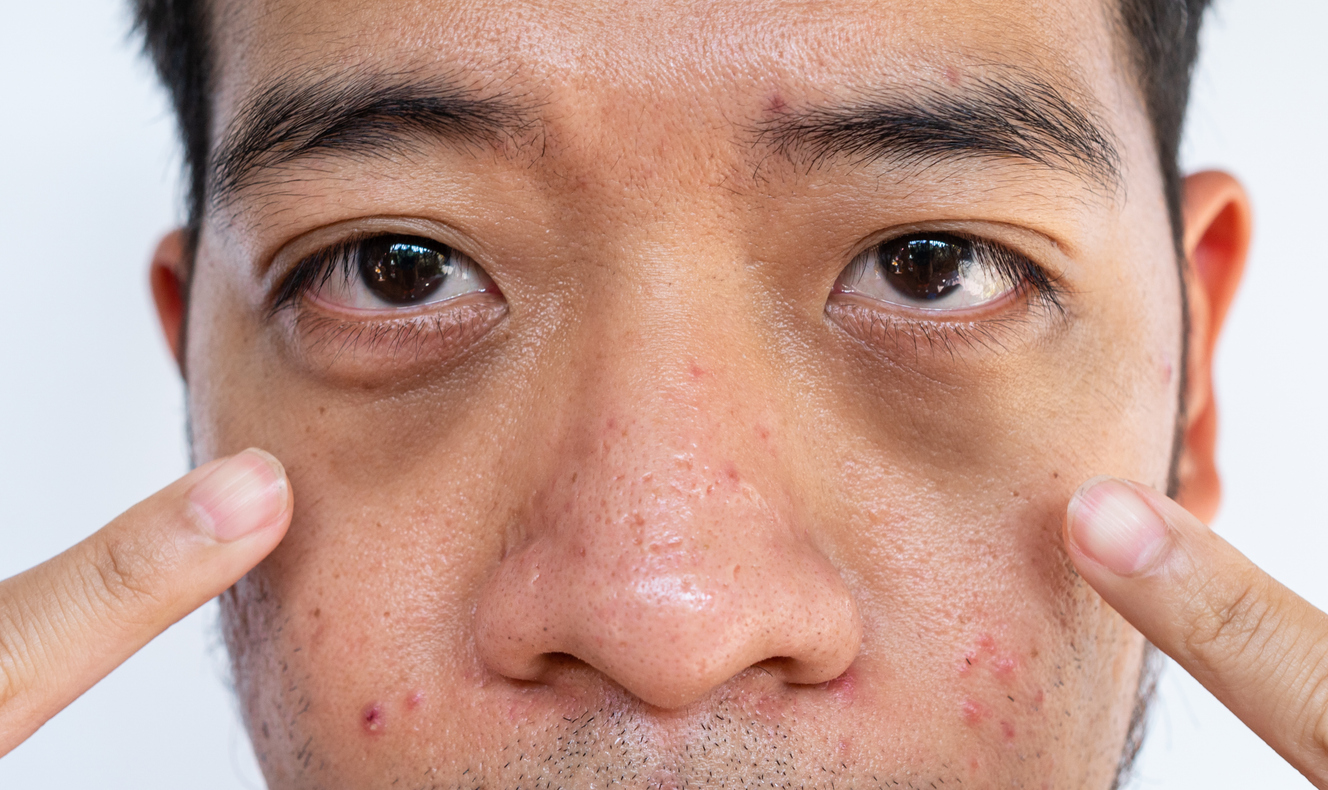 Dark circles can occur due to multiple reasons but medical treatment is necessary when it become too dark