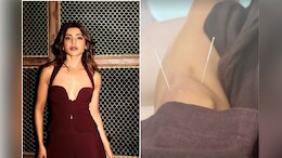 5 Beauty Benefits Of Acupuncture Which Will Make You Choose It Like Samantha Ruth Prabhu Did