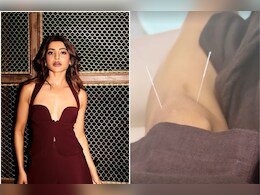 5 Beauty Benefits Of Acupuncture Which Will Make You Choose It Like Samantha Ruth Prabhu Did 5 Beauty Benefits Of Acupuncture Which Will Make You Choose It Like Samantha Ruth Prabhu Did