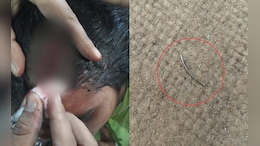 Doctor At UP Hospital Forgets Surgical Needle Inside Woman's Head, Probe On