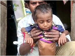 NDTV Ground Report: राजस्थान के बारां में सैकड़ों आदिवासी बच्चे कुपोषित, 1 बेड पर चल रहा 3 का इलाज, डॉक्टर्स की कमी