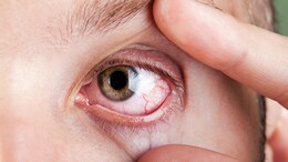 Causes Of Dry Eyes In Winter And Treatment