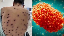 UAE से केरल लौटे 38 साल के शख्स में मिले मंकीपॉक्स के लक्षण