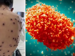 UAE से केरल लौटे 38 साल के शख्स में मिले मंकीपॉक्स के लक्षण UAE से केरल लौटे 38 साल के शख्स में मिले मंकीपॉक्स के लक्षण
