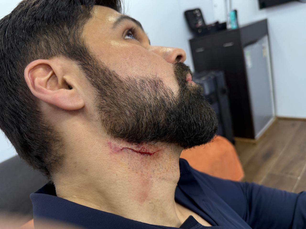 Emraan Hashmi Injured On <i>Goodachari 2</i> Set In Hyderabad