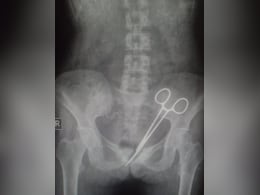 डॉक्टरों की गंभीर लापरवाही: सर्जरी के बाद महिला के पेट में 12 साल तक पड़ी रही सर्जिकल कैंची!