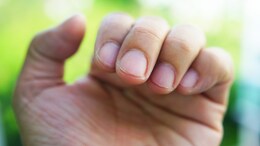5 Things Your Nails Are Telling You About Your Health, As Shared By A Nutritionist