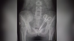 Doctors Leave Pair Of Scissors In Woman's Abdomen, It Is Found 12 Years Later