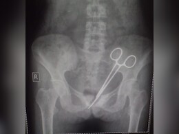 Doctors Leave Pair Of Scissors In Woman's Abdomen, It Is Found 12 Years Later