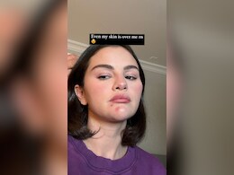 Selena Gomez's Acne Isn't "Over" Her And Neither Are We For Her Unfiltered Realness Selena Gomez's Acne Isn't "Over" Her And Neither Are We For Her Unfiltered Realness