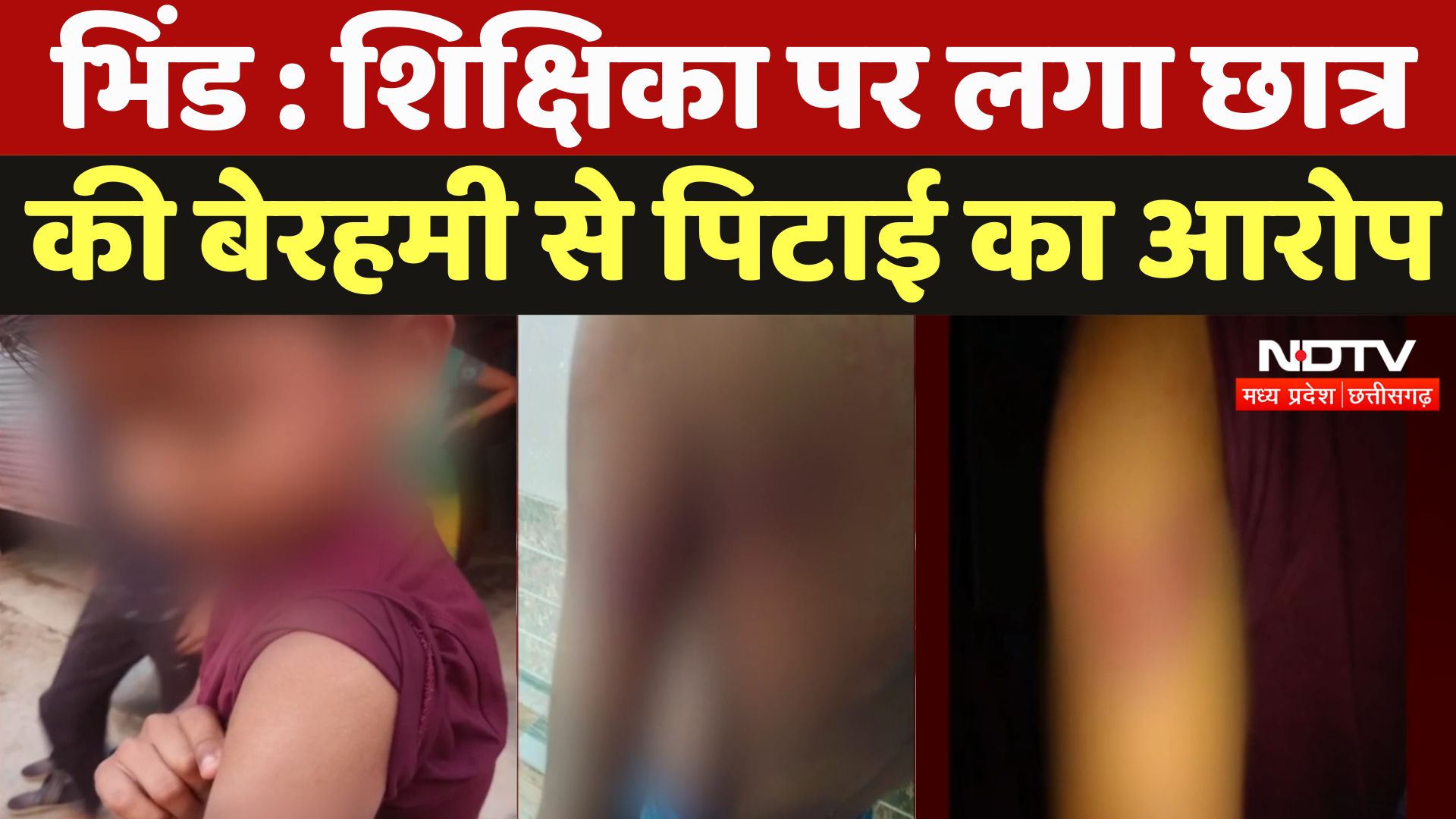 Bhind : शिक्षिका पर लगा छात्र की बेरहमी से पिटाई का आरोप