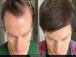 Tech Millionaire Bryan Johnson Reveals How He Reversed His Hair Loss, Shares Tactics Tech Millionaire Bryan Johnson Reveals How He Reversed His Hair Loss, Shares Tactics