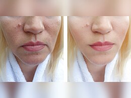 झाईंयों से चेहरा पूरा भर गया है तो इन चीजों में से रोज रात में एक लगाइए, 21 दिन में सारे दाग-धब्बे हो जाएंगे गायब