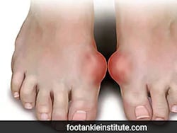 Scientists Restore Ancient Gene To Help Treat Gout And Uric Acid Disorders