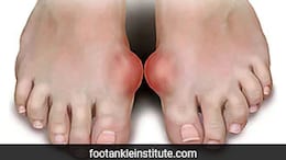 Study Reveals Surprising Factor Behind Gout - It's Not What You Think