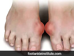 Scientists Restore Ancient Gene To Help Treat Gout And Uric Acid Disorders Scientists Restore Ancient Gene To Help Treat Gout And Uric Acid Disorders