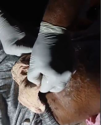 Gauze Left In Woman\'s Stomach During Surgery At Bihar Hospital