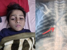 MP के शुभम को राजस्थान में मिला 'जीवनदान', डॉक्टर्स ने 2 मिनट में ऑपरेशन करके बचाई जान