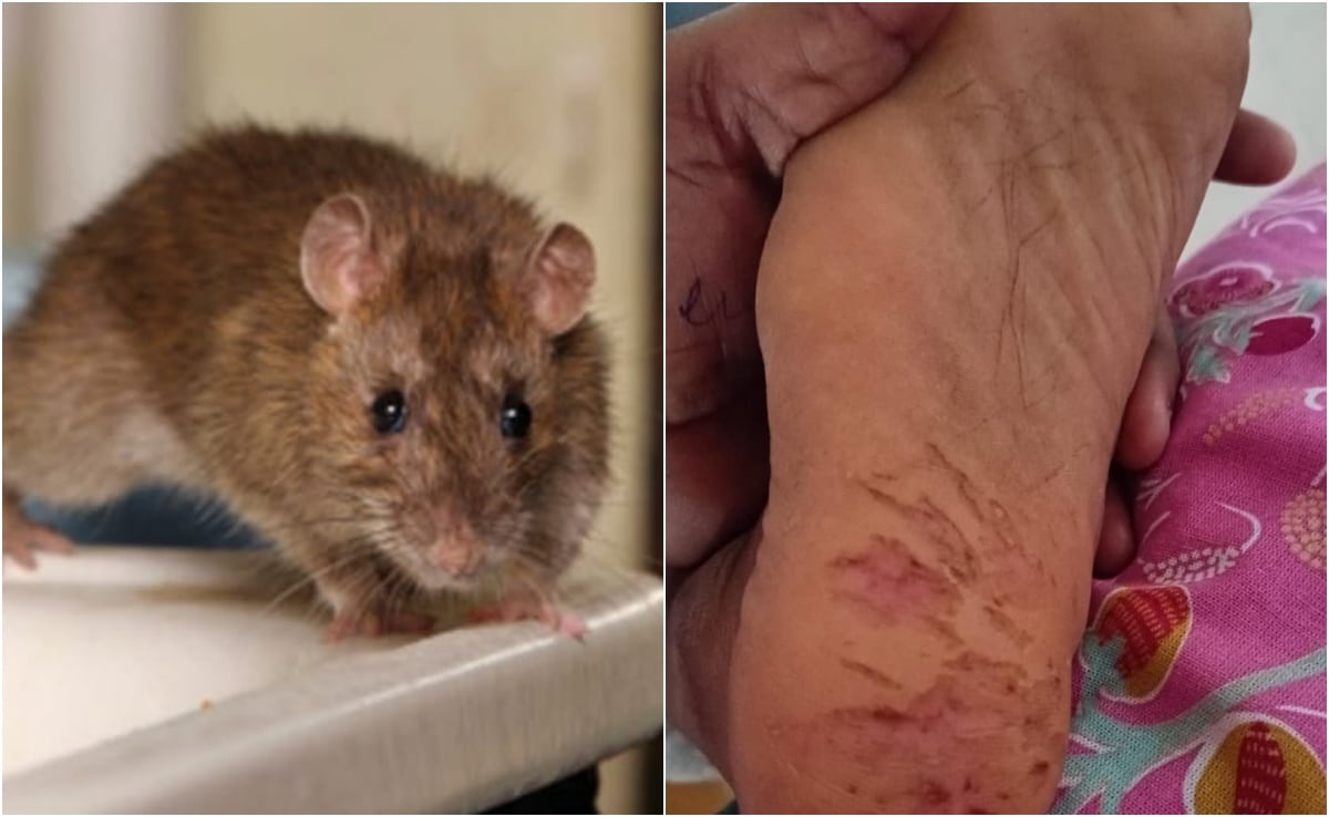 তেলেঙ্গানা: 8 মাসে 15 বার ইঁদুরের কামড়ে মেয়ে পক্ষাঘাতগ্রস্ত, পরিবারের অভিযোগ তেলেঙ্গানা: 8 মাসে 15 বার ইঁদুরের কামড়ে মেয়ে পক্ষাঘাতগ্রস্ত, পরিবারের অভিযোগ