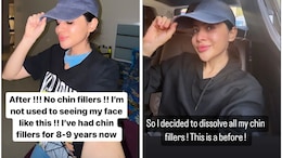 "Not Used To Seeing My Face Like This", Uorfi Javed As She Gets Her Chin Fillers Dissolved After Nine Years