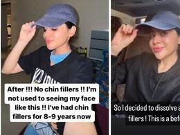 "Not Used To Seeing My Face Like This", Uorfi Javed As She Gets Her Chin Fillers Dissolved After Nine Years "Not Used To Seeing My Face Like This", Uorfi Javed As She Gets Her Chin Fillers Dissolved After Nine Years