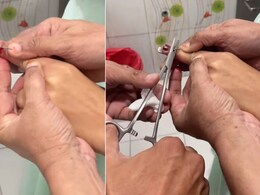 महिला के हाथ की उंगली के आर-पार हुई सिलाई मशीन की सुई, डॉक्टर के इलाज का तरीका देख लोग बोले- ये थोड़ा कैजुअल है