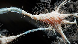 Scientists Find Molecule That Blocks Brain Cell Death In Parkinson's, Alzheimer's