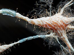 Scientists Find Molecule That Blocks Brain Cell Death In Parkinson's, Alzheimer's