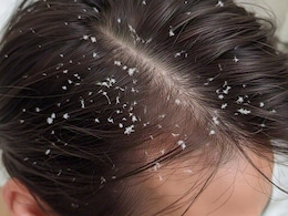 100% घरेलू नुस्खा डैंड्रफ से छुटकारा पाने का जानिए यहां, एकबार में हो जाएगी सारी रूसी बालों से साफ