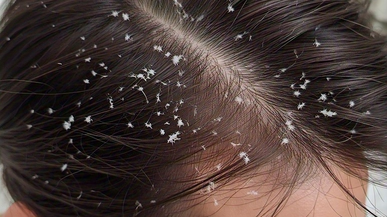 100% घरेलू नुस्खा डैंड्रफ से छुटकारा पाने का जानिए यहां, एकबार में हो जाएगी सारी रूसी बालों से साफ