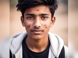 Teen Acne: जवानी में चेहरे पर ग्लो की बजाए बढ़ रहे हैं एक्ने और मुहांसे, जान लीजिए मुंहासे हटाने के उपाय