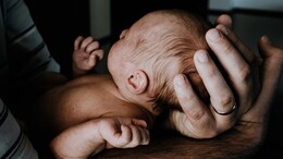 Babies In Spain Develop 'Werewolf Syndrome' After Parents Use Hair-Loss Drug: Report