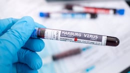 Marburg Disease: How To Keep Yourself Safe From The Bleeding Eye Virus