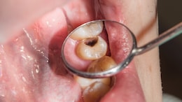 Not Just Sugar; These Foods Can Also Increase Your Risk Of Cavities