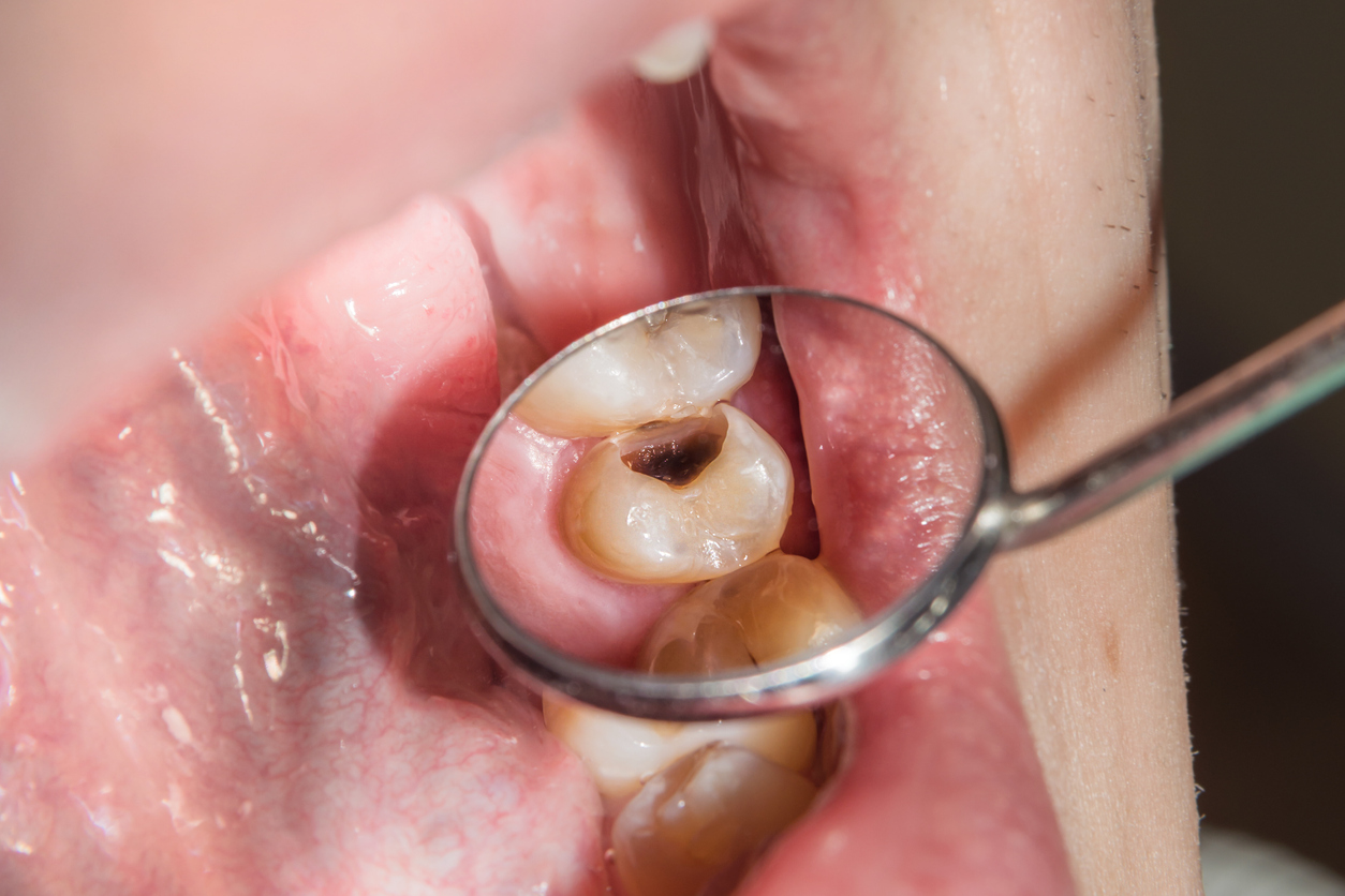 While sugar is a well-known cause of cavities, many other foods can also increase the risk
