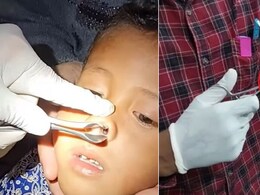 VIDEO:महीने भर से बच्चे की नाक में बैठकर खून चूस रहा था जोंक, होने लगी ब्लीडिंग तो खुला राज VIDEO:महीने भर से बच्चे की नाक में बैठकर खून चूस रहा था जोंक, होने लगी ब्लीडिंग तो खुला राज