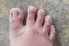 सर्दियों में क्यों सूज जाती हैं हाथ और पैरों की उंगलियां? ऐसे मिलेगी राहत