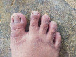 ठंड के मौसम में क्यों सूज जाती हैं पैरों की उंगलियां? जानिए किन घरेलू नुस्खों से मिलेगी सर्दियों में होने वाले दर्द और तकलीफ से राहत ठंड के मौसम में क्यों सूज जाती हैं पैरों की उंगलियां? जानिए किन घरेलू नुस्खों से मिलेगी सर्दियों में होने वाले दर्द और तकलीफ से राहत