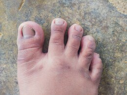 सर्दियों में उंगलियों की सूजन को कैसे ठीक करें? चमत्कारी उपाय से कम नहीं हैं ये 5 देसी घरेलू नुस्खे