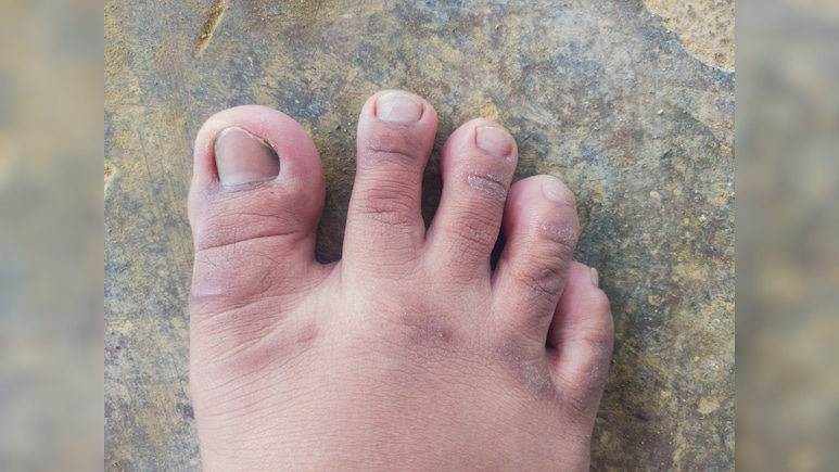 सर्दियों में उंगलियों की सूजन को कैसे ठीक करें? चमत्कारी उपाय से कम नहीं हैं ये 5 देसी घरेलू नुस्खे