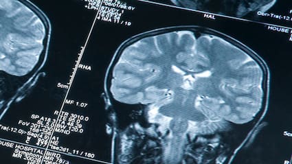 Scientists Are Growing Mini Human Brains In Labs