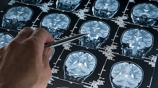 Scientists Are Growing Mini Human Brains In Labs