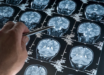 Scientists Reprogram Brain Immune Cells To Fight Alzheimer's: Study