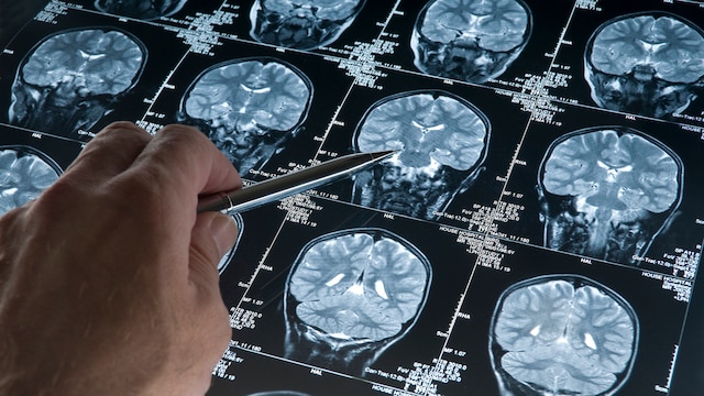Alzheimer's disease is the most common cause of dementia