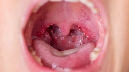 What Is Tonsil Stone: All You Need To Know About Tonsillotiths
