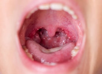 What Is Tonsil Stone: All You Need To Know About Tonsillotiths